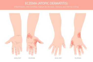 Egzama. Deri iltihabı. Deri hastalıkları. Tıbbi bilgi tasarımı. Vektör illüstrasyonu