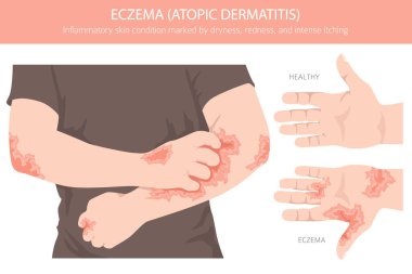Egzama. Deri iltihabı. Deri hastalıkları. Tıbbi bilgi tasarımı. Vektör illüstrasyonu