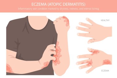 Egzama. Deri iltihabı. Deri hastalıkları. Tıbbi bilgi tasarımı. Vektör illüstrasyonu