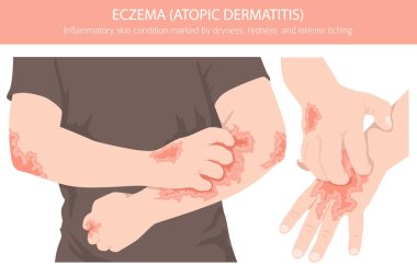 Egzama. Deri iltihabı. Deri hastalıkları. Tıbbi bilgi tasarımı. Vektör illüstrasyonu