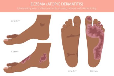 Egzama. Deri iltihabı. Deri hastalıkları. Tıbbi bilgi tasarımı. Vektör illüstrasyonu