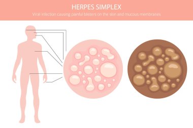Uçuk Simplex. Deri hastalıkları. Tıbbi bilgi tasarımı. Vektör illüstrasyonu
