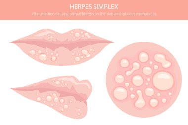 Uçuk Simplex. Deri hastalıkları. Tıbbi bilgi tasarımı. Vektör illüstrasyonu