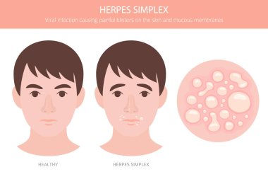 Uçuk Simplex. Deri hastalıkları. Tıbbi bilgi tasarımı. Vektör illüstrasyonu