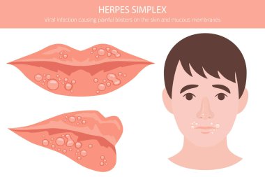 Uçuk Simplex. Deri hastalıkları. Tıbbi bilgi tasarımı. Vektör illüstrasyonu