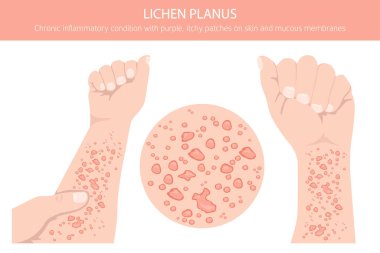 Lichen Planus. Deri hastalıkları. Tıbbi bilgi tasarımı. Vektör illüstrasyonu