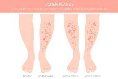 Lichen Planus. Deri hastalıkları. Tıbbi bilgi tasarımı. Vektör illüstrasyonu