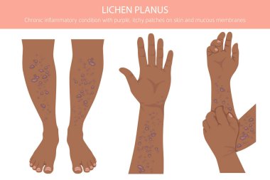 Lichen Planus. Deri hastalıkları. Tıbbi bilgi tasarımı. Vektör illüstrasyonu