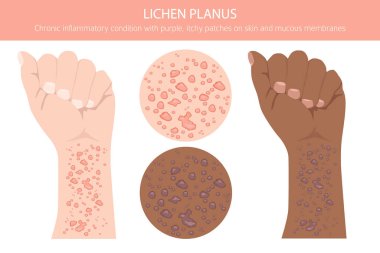Lichen Planus. Deri hastalıkları. Tıbbi bilgi tasarımı. Vektör illüstrasyonu