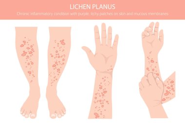 Lichen Planus. Deri hastalıkları. Tıbbi bilgi tasarımı. Vektör illüstrasyonu