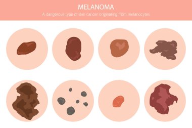 Melanoma. Deri hastalıkları. Tıbbi bilgi tasarımı. Vektör illüstrasyonu
