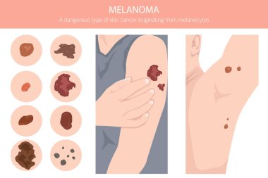Melanoma. Deri hastalıkları. Tıbbi bilgi tasarımı. Vektör illüstrasyonu