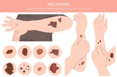 Melanoma. Deri hastalıkları. Tıbbi bilgi tasarımı. Vektör illüstrasyonu