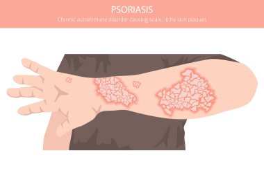 Sedef hastalığı. Deri hastalıkları. Tıbbi bilgi tasarımı. Vektör illüstrasyonu