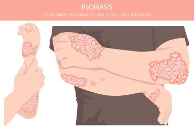 Sedef hastalığı. Deri hastalıkları. Tıbbi bilgi tasarımı. Vektör illüstrasyonu