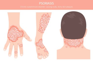 Sedef hastalığı. Deri hastalıkları. Tıbbi bilgi tasarımı. Vektör illüstrasyonu