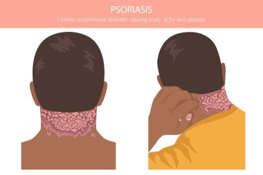 Sedef hastalığı. Deri hastalıkları. Tıbbi bilgi tasarımı. Vektör illüstrasyonu