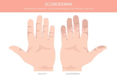 Skleroderma. Deri hastalıkları. Tıbbi bilgi tasarımı. Vektör illüstrasyonu