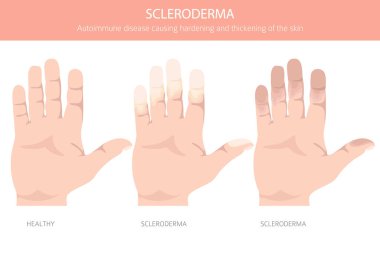 Skleroderma. Deri hastalıkları. Tıbbi bilgi tasarımı. Vektör illüstrasyonu