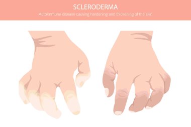 Skleroderma. Deri hastalıkları. Tıbbi bilgi tasarımı. Vektör illüstrasyonu