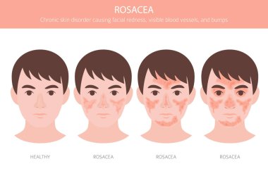 Rosacea. Deri hastalıkları. Tıbbi bilgi tasarımı. Vektör illüstrasyonu
