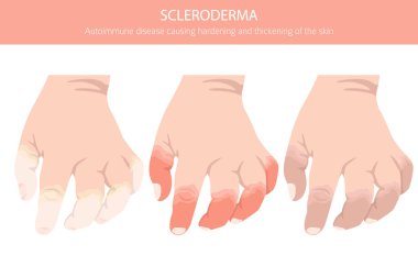 Skleroderma. Deri hastalıkları. Tıbbi bilgi tasarımı. Vektör illüstrasyonu