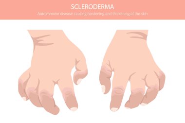 Skleroderma. Deri hastalıkları. Tıbbi bilgi tasarımı. Vektör illüstrasyonu