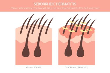 Seborrheic dermatitis. Deri hastalıkları. Tıbbi bilgi tasarımı. Vektör illüstrasyonu