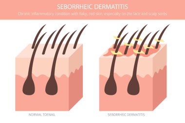 Seborrheic dermatitis. Deri hastalıkları. Tıbbi bilgi tasarımı. Vektör illüstrasyonu