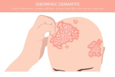 Seborrheic dermatitis. Deri hastalıkları. Tıbbi bilgi tasarımı. Vektör illüstrasyonu