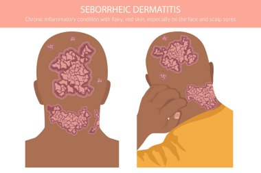 Seborrheic dermatitis. Deri hastalıkları. Tıbbi bilgi tasarımı. Vektör illüstrasyonu