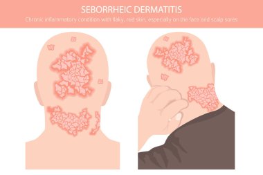 Seborrheic dermatitis. Deri hastalıkları. Tıbbi bilgi tasarımı. Vektör illüstrasyonu
