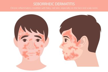 Seborrheic dermatitis. Deri hastalıkları. Tıbbi bilgi tasarımı. Vektör illüstrasyonu