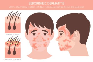 Seborrheic dermatitis. Deri hastalıkları. Tıbbi bilgi tasarımı. Vektör illüstrasyonu