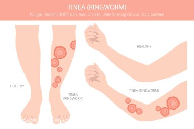 Tinea. Kurtçuk. Deri hastalıkları. Tıbbi bilgi tasarımı. Vektör illüstrasyonu