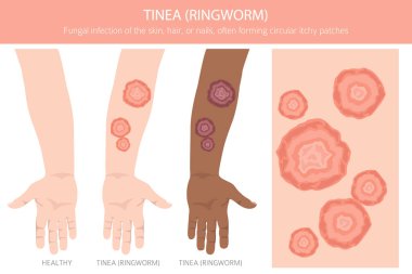 Tinea. Kurtçuk. Deri hastalıkları. Tıbbi bilgi tasarımı. Vektör illüstrasyonu