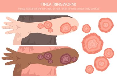 Tinea. Kurtçuk. Deri hastalıkları. Tıbbi bilgi tasarımı. Vektör illüstrasyonu