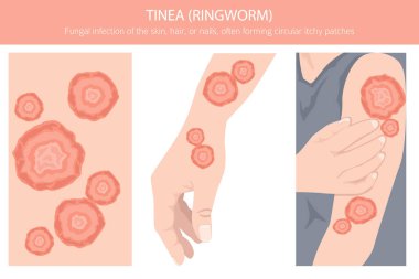 Tinea. Kurtçuk. Deri hastalıkları. Tıbbi bilgi tasarımı. Vektör illüstrasyonu