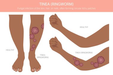 Tinea. Kurtçuk. Deri hastalıkları. Tıbbi bilgi tasarımı. Vektör illüstrasyonu