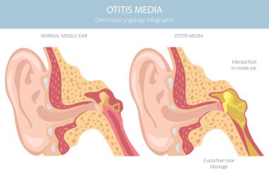 Otitis medyası. Orta kulakta enfeksiyon var. Otolojik bozukluklar bilgisi. Vektör illüstrasyonu