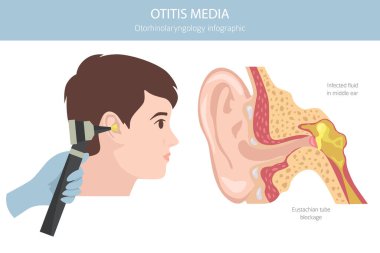 Otitis medyası. Orta kulakta enfeksiyon var. Otolojik bozukluklar bilgisi. Vektör illüstrasyonu
