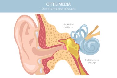 Otitis medyası. Orta kulakta enfeksiyon var. Otolojik bozukluklar bilgisi. Vektör illüstrasyonu