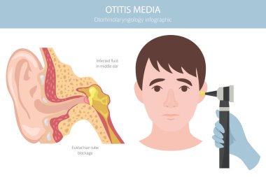 Otitis medyası. Orta kulakta enfeksiyon var. Otolojik bozukluklar bilgisi. Vektör illüstrasyonu
