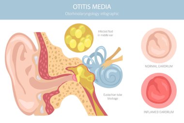 Otitis medyası. Orta kulakta enfeksiyon var. Otolojik bozukluklar bilgisi. Vektör illüstrasyonu