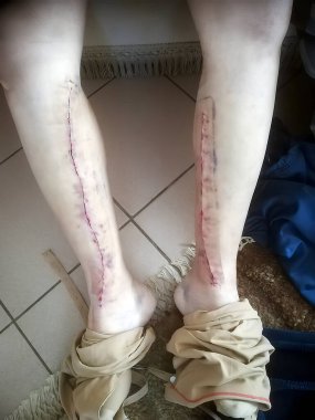 Dört kez bypass ameliyatı olduktan birkaç gün sonra bacağındaki damarları çözülebilir dikişlerle kullanan bir adamın gerçek resmi.