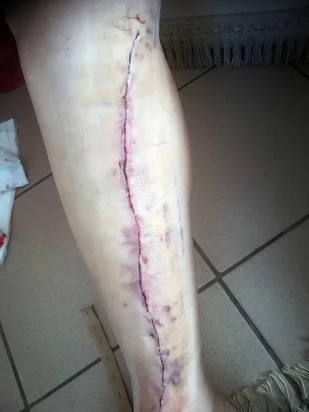 Real close-up picture of the leg of a man after receiving heart bypass surgery using veins from his legs using dissolvable stitches