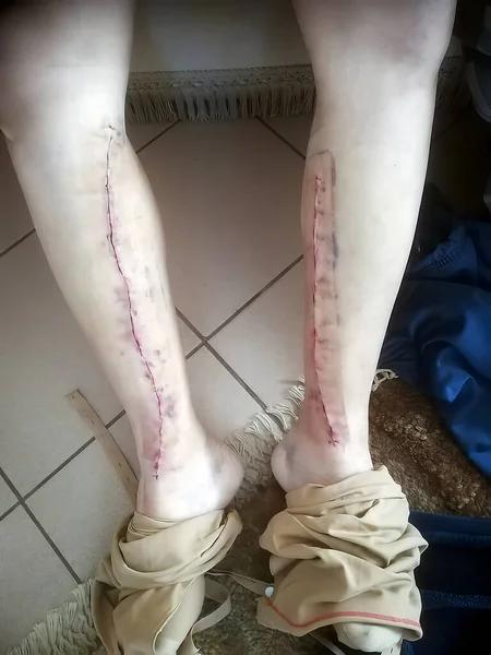 Real picture of the legs of a man a few days after receiving quadruple heart bypass surgery using veins from his legs using dissolvable stitches