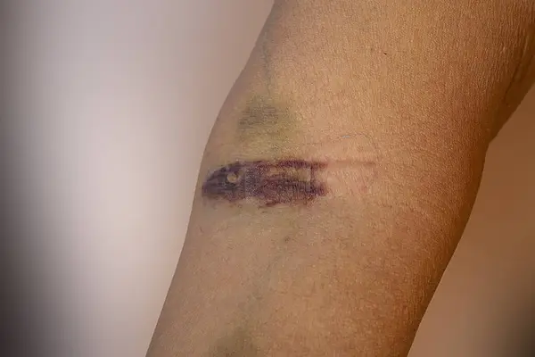 detail of a bruise on an arm due to a blood draw with a syringe