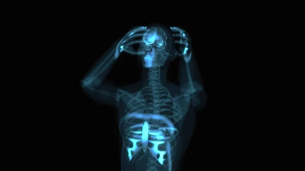 要約心臓発作の3Dイラスト 解剖学 — ストック写真