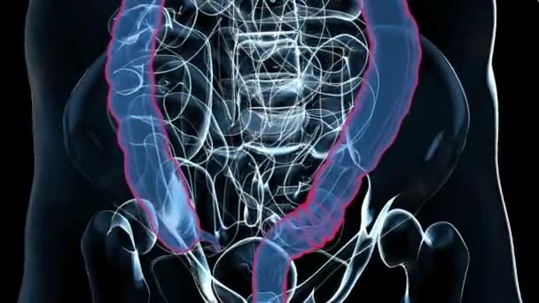 结肠癌的三维图像 — 图库视频影像